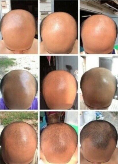 4x 120ml Neo Hair Lotion Green Wealth Growth Root Nutrients Hair Loss Skin Hair