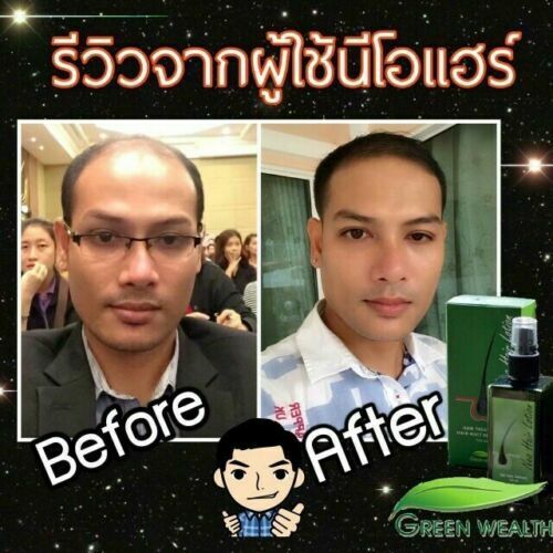 2X120ml Green Wealth Neo Hair Lotion Growth Root Hair Loss Nutrients Treatments