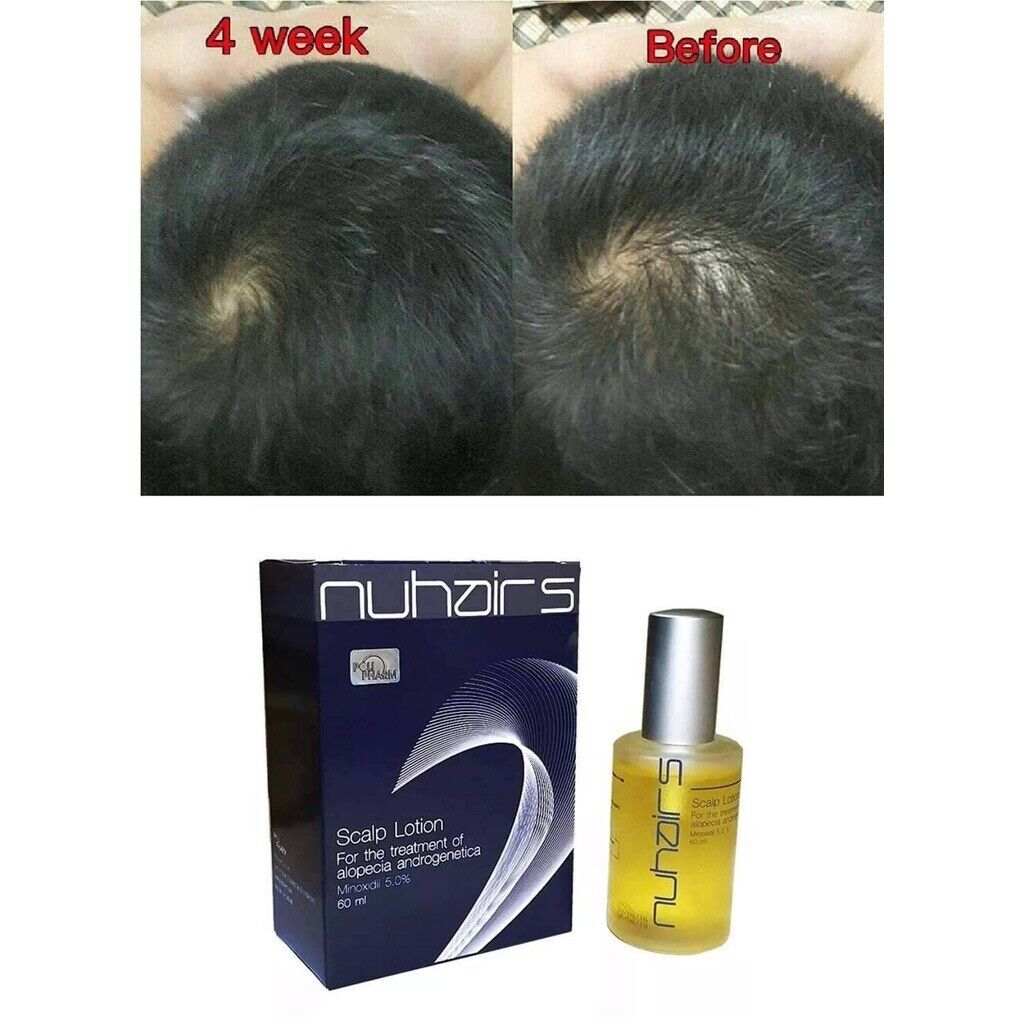 Nuhair 5 Hair Loss Alopecia Androgenetica Male Baldness Hair Lotion Hair Growth