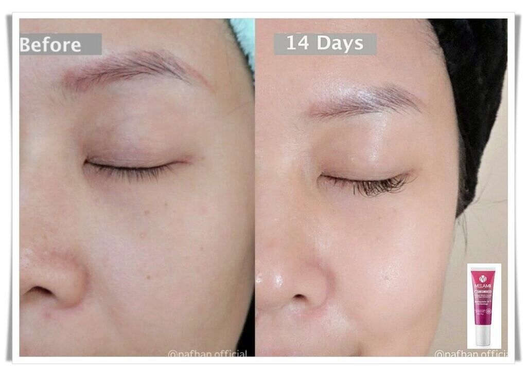 Melamii Anti-Melasma cream reduce dark spots white serum skin