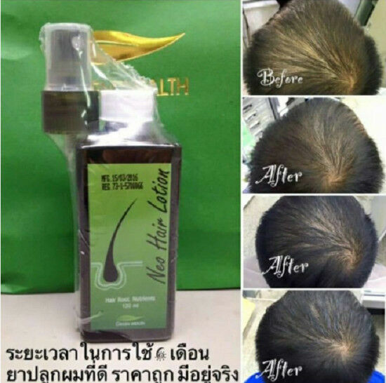 1X 120 ml. Green Wealth Neo Hair Lotion Root Nutrients Hair Loss Treatments