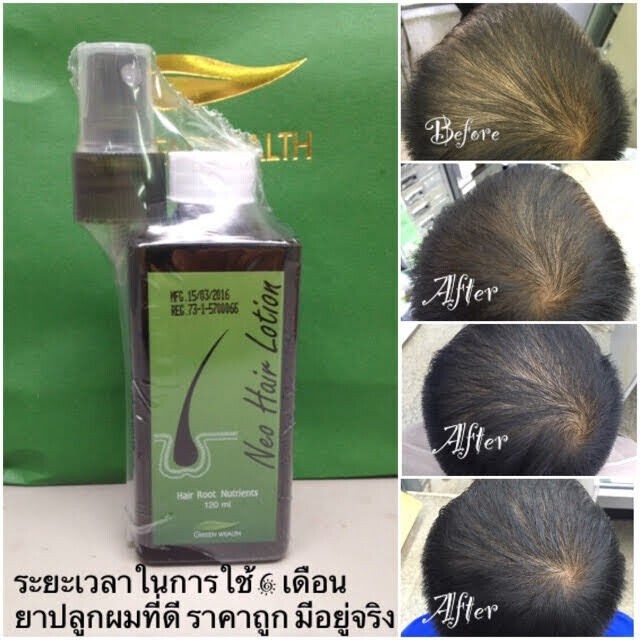 4x 120ml Neo Hair Lotion Green Wealth Growth Root Nutrients Hair Loss Skin Hair