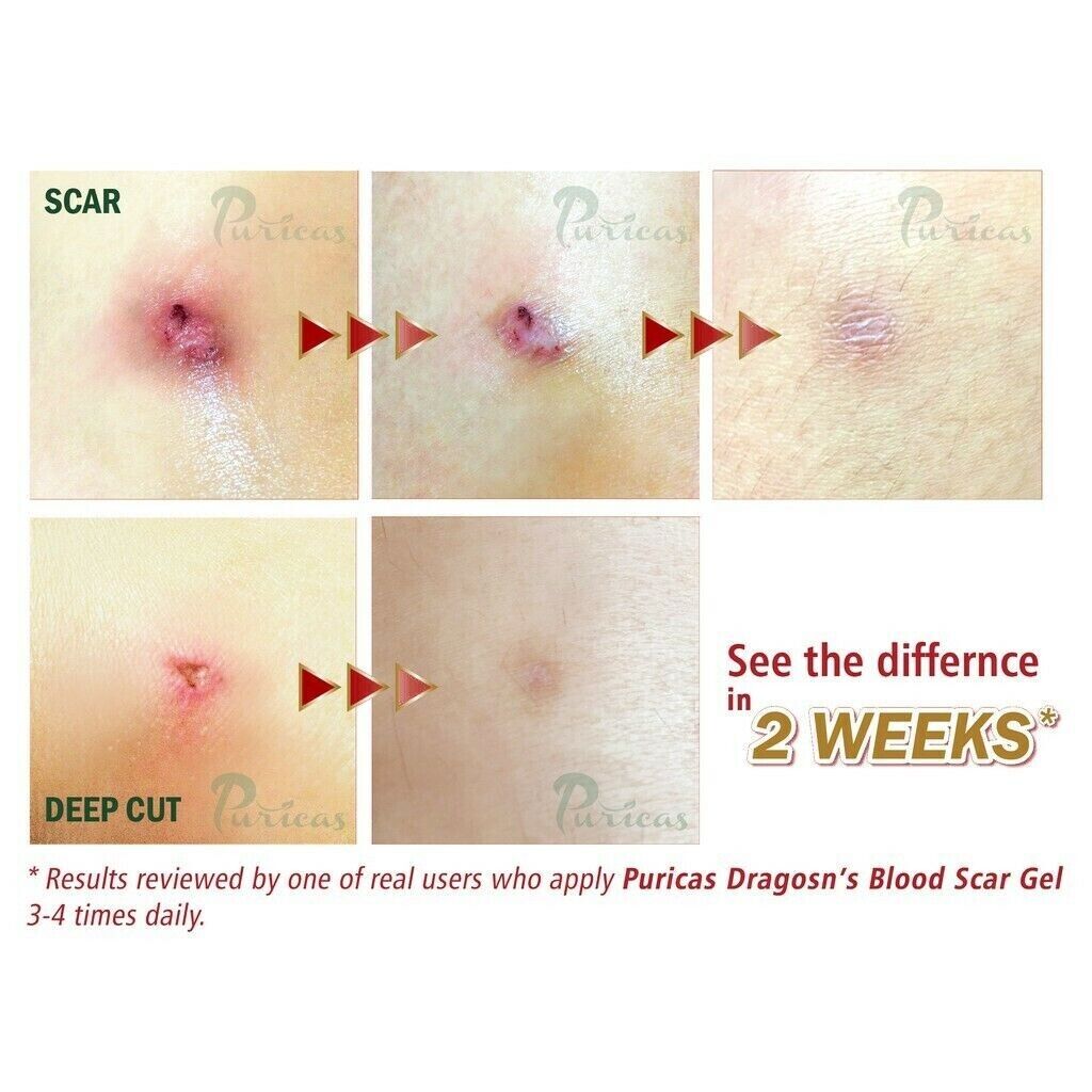 20 g Puricas Dragon's Blood Scar Gel Treat Keloid Surgery Acne Scars Dark spots