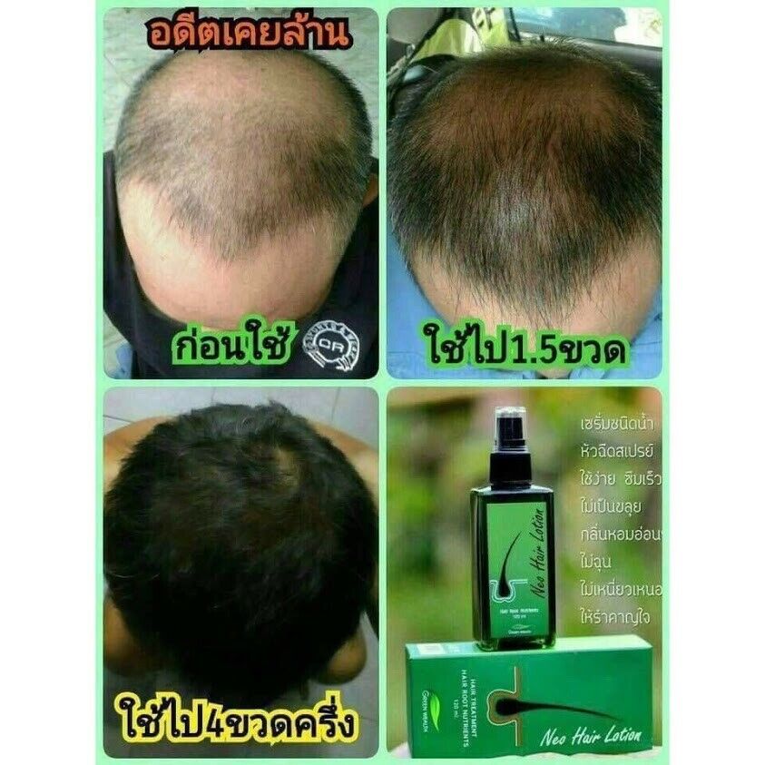 8x Neo Hair Lotion Green Wealth Growth Root Nutrients Hair Loss Treatments Herbs
