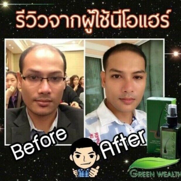 6x120ml Green Wealth Neo Neo Hair Lotion Root Nutrients Treatments Hair Loss