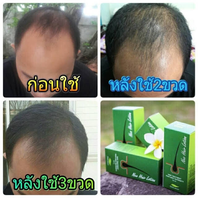 4x 120ml Neo Hair Lotion Green Wealth Growth Root Nutrients Hair Loss Skin Hair