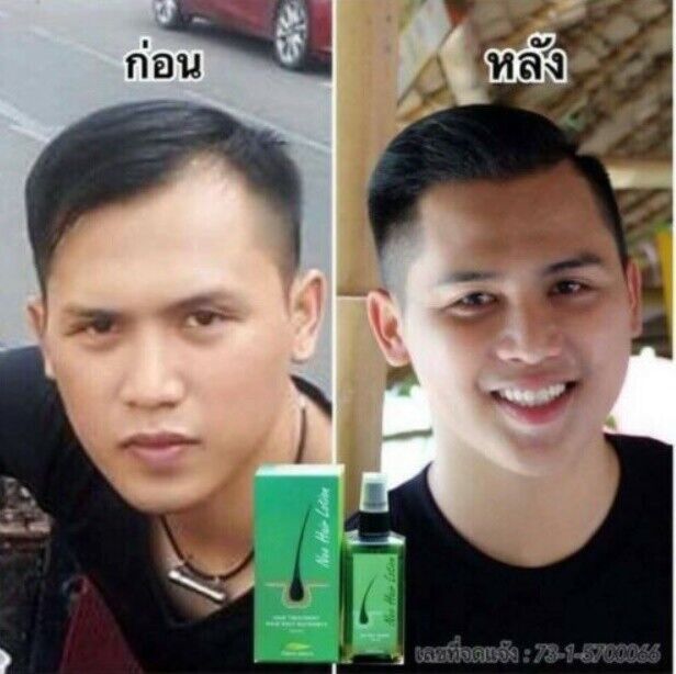 8x Neo Hair Lotion Green Wealth Growth Root Nutrients Hair Loss Treatments Herbs