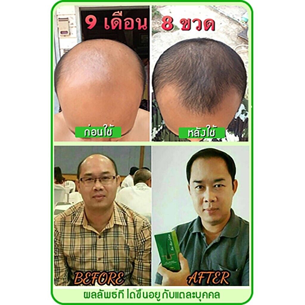 6x Neo Hair Lotion Root Treatment Nutrients for Loss Hair, Longer Hair 120 ml